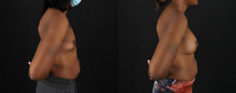 Breast Augmentation case #6432