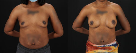 Breast Augmentation case #6432