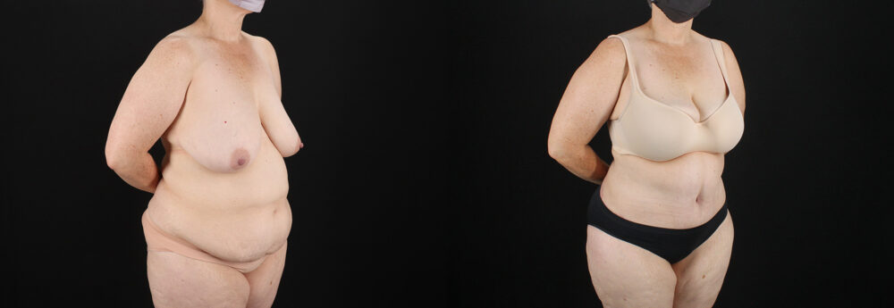 Tummy Tuck case #7615