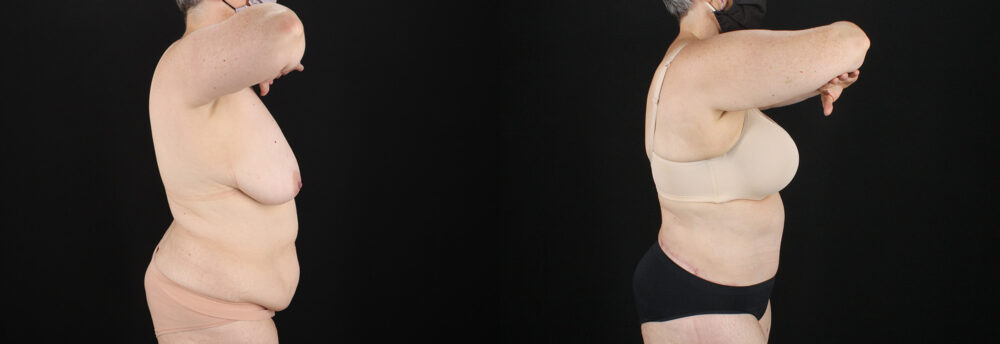 Tummy Tuck case #7615