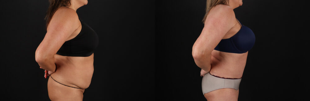 Tummy Tuck case #7625