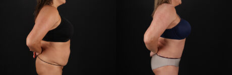 Tummy Tuck case #7625