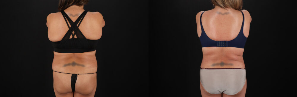 Tummy Tuck case #7625