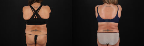 Tummy Tuck case #7625