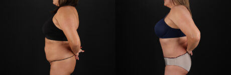 Tummy Tuck case #7625