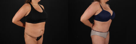 Tummy Tuck case #7625