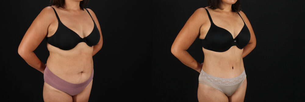 Tummy Tuck case #7614