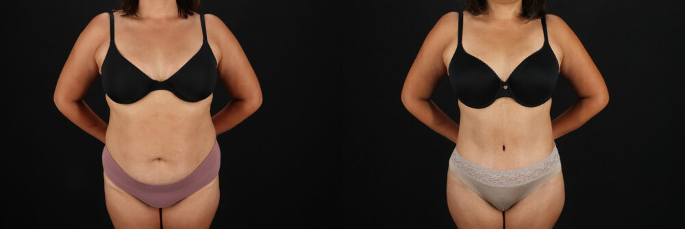 Tummy Tuck case #7614