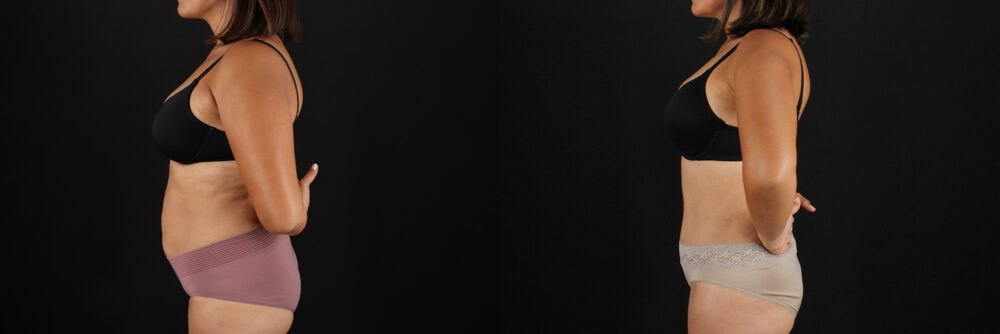 Tummy Tuck case #7614