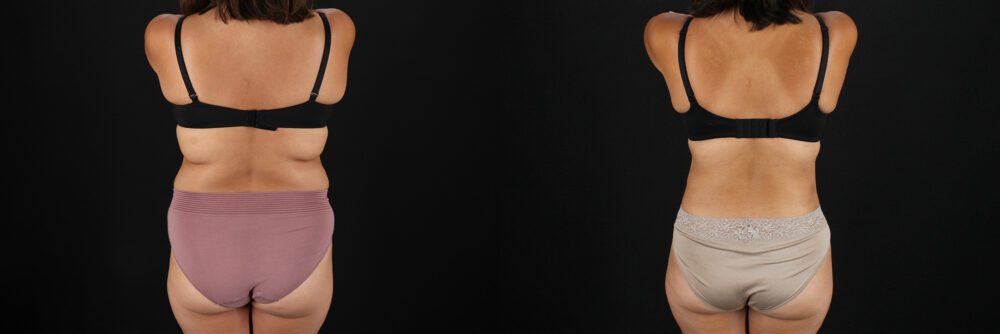 Tummy Tuck case #7614