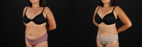 Tummy Tuck case #7614