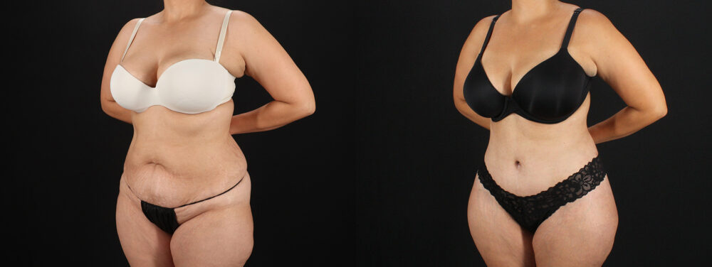 Tummy Tuck case #7613