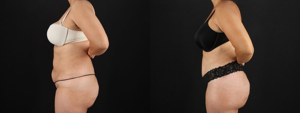 Tummy Tuck case #7613