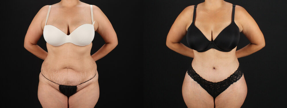 Tummy Tuck case #7613
