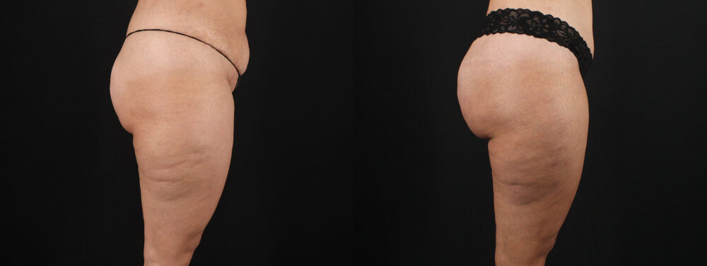 Tummy Tuck case #7613