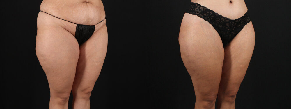 Tummy Tuck case #7613