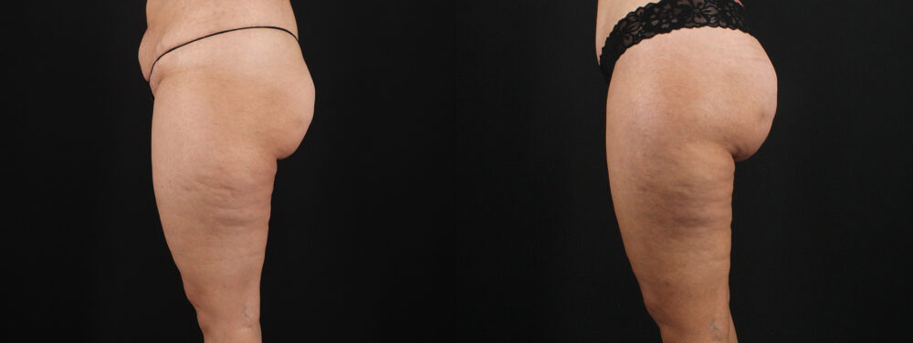 Tummy Tuck case #7613