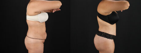 Tummy Tuck case #7613