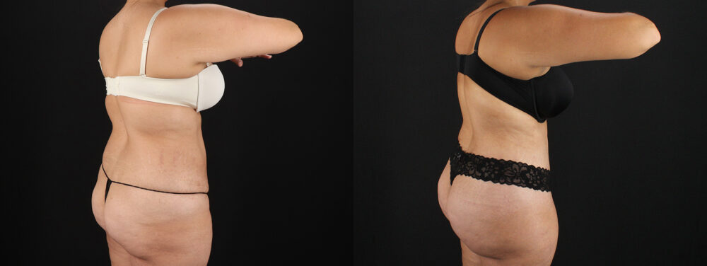 Tummy Tuck case #7613