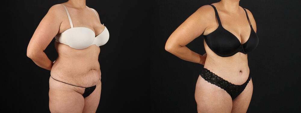 Tummy Tuck case #7613