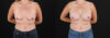 Breast Augmentation case #6438 slider thumbnail
