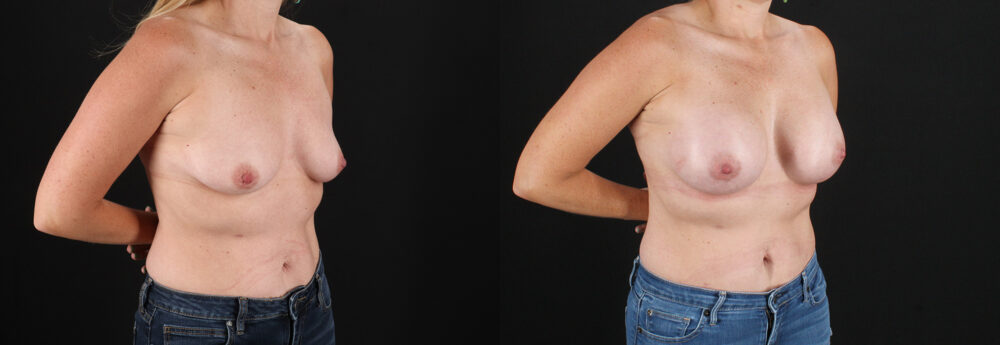 Breast Augmentation case #6438