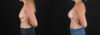 Breast Augmentation case #6438 slider thumbnail