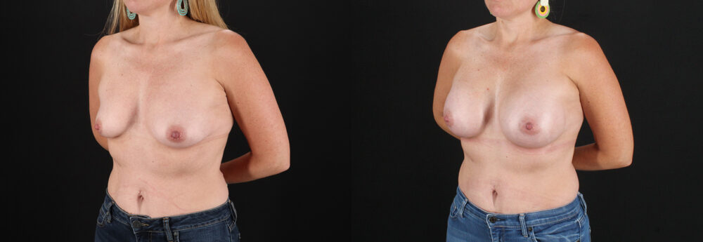 Breast Augmentation case #6438