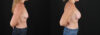 Breast Augmentation case #6438 slider thumbnail