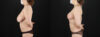 Breast Reduction case #7994 slider thumbnail