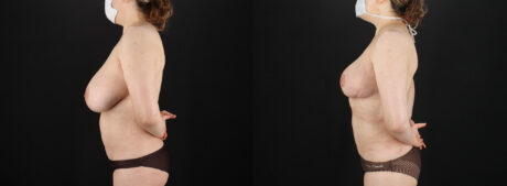 Breast Reduction case #7994