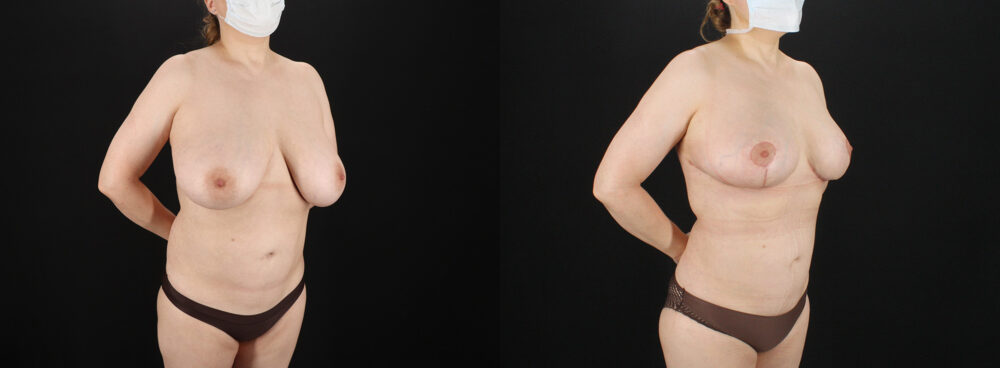 Breast Reduction case #7994