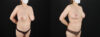 Breast Reduction case #7994 slider thumbnail