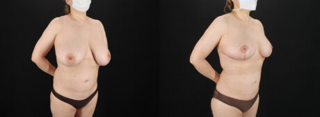 Breast Reduction case #7994