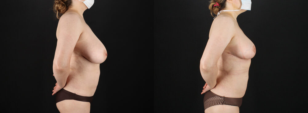 Breast Reduction case #7994