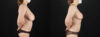 Breast Reduction case #7994 slider thumbnail
