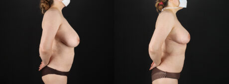 Breast Reduction case #7994