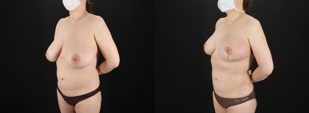 Breast Reduction case #7994