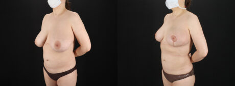 Breast Reduction case #7994