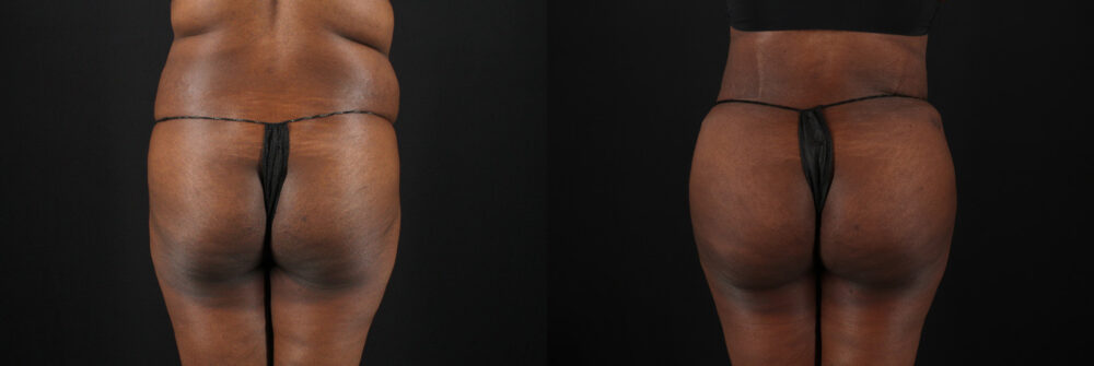 Tummy Tuck case #7620