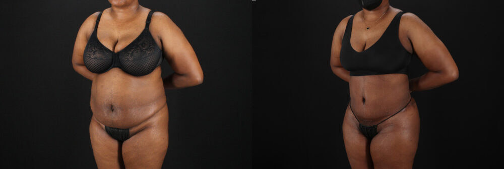 Tummy Tuck case #7620