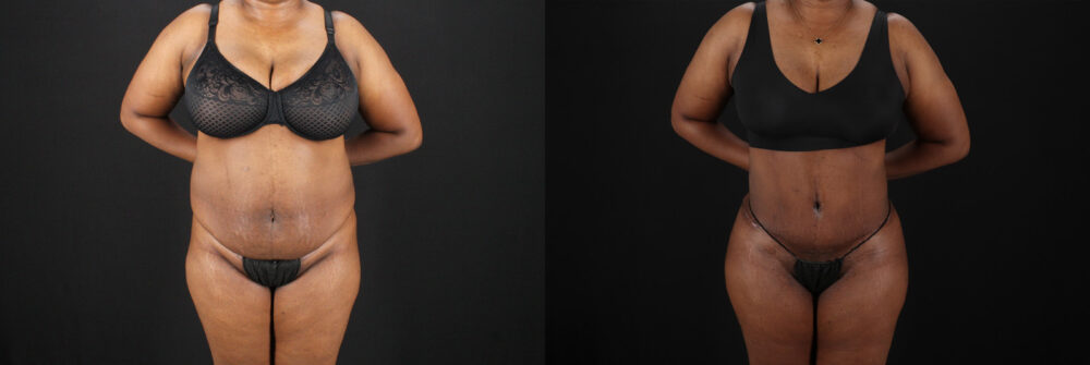 Tummy Tuck case #7620