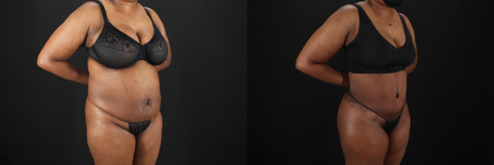 Tummy Tuck case #7620