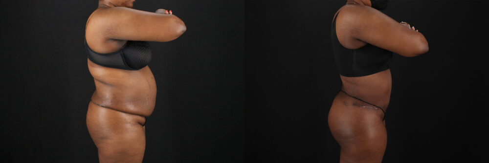 Tummy Tuck case #7620