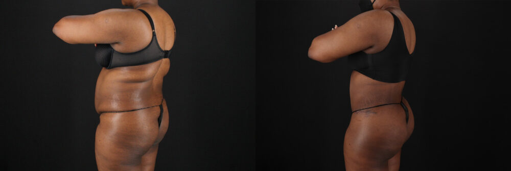 Tummy Tuck case #7620