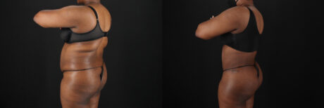 Tummy Tuck case #7620