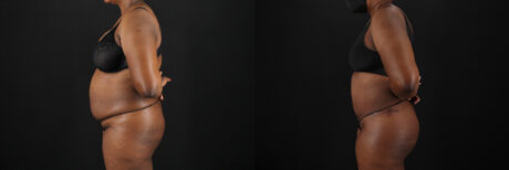 Tummy Tuck case #7620