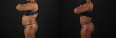 Tummy Tuck case #7620