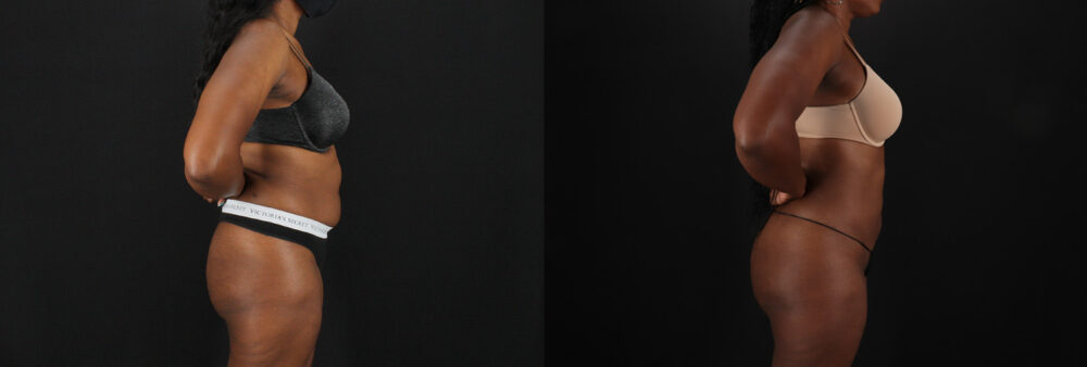 Brazilian Butt Lift case #5455