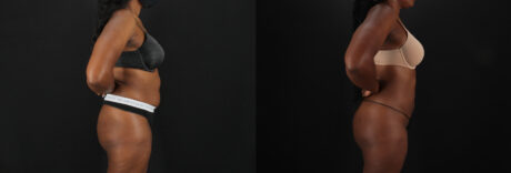 Brazilian Butt Lift case #5455